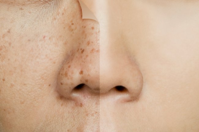 पिगमेंटेशन (झाइयां) के लक्षण, कारण, घरेलू इलाज